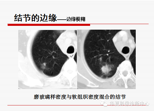 孤立性肺结节/肿块及相关CT征像判断的准则