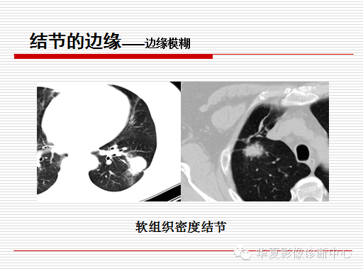 孤立性肺结节/肿块及相关CT征像判断的准则
