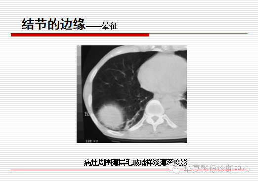 孤立性肺结节/肿块及相关CT征像判断的准则