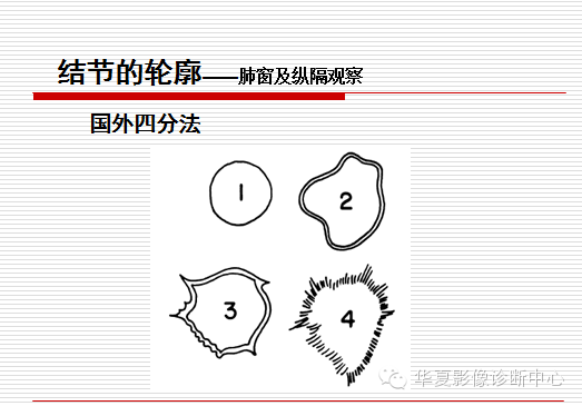 孤立性肺结节/肿块及相关CT征像判断的准则