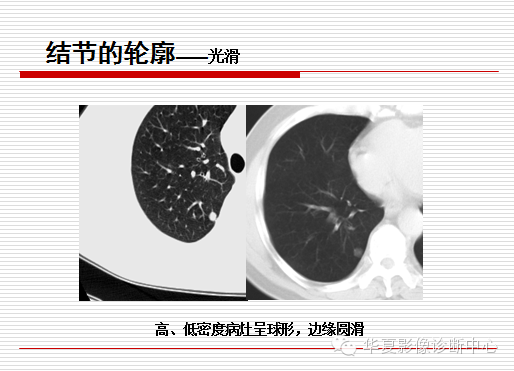 孤立性肺结节/肿块及相关CT征像判断的准则