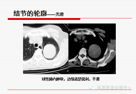 孤立性肺结节/肿块及相关CT征像判断的准则