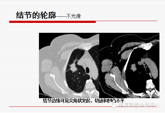 孤立性肺结节/肿块及相关CT征像判断的准则