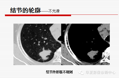 孤立性肺结节/肿块及相关CT征像判断的准则