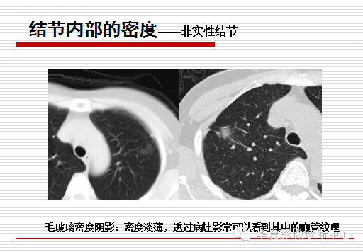 孤立性肺结节/肿块及相关CT征像判断的准则