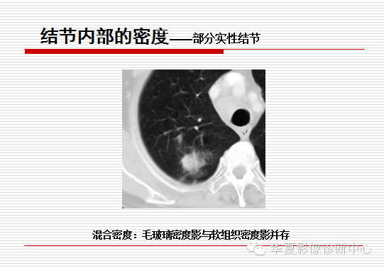 孤立性肺结节/肿块及相关CT征像判断的准则