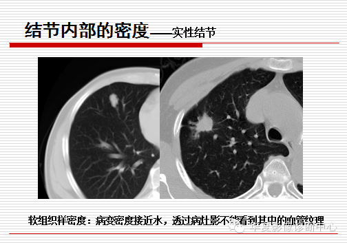 孤立性肺结节/肿块及相关CT征像判断的准则