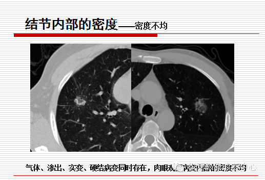 孤立性肺结节/肿块及相关CT征像判断的准则