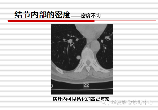 孤立性肺结节/肿块及相关CT征像判断的准则