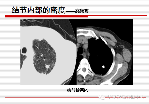 孤立性肺结节/肿块及相关CT征像判断的准则