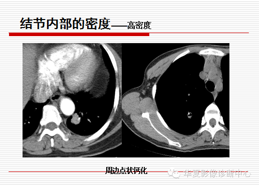 孤立性肺结节/肿块及相关CT征像判断的准则