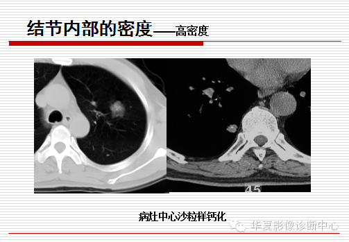 孤立性肺结节/肿块及相关CT征像判断的准则