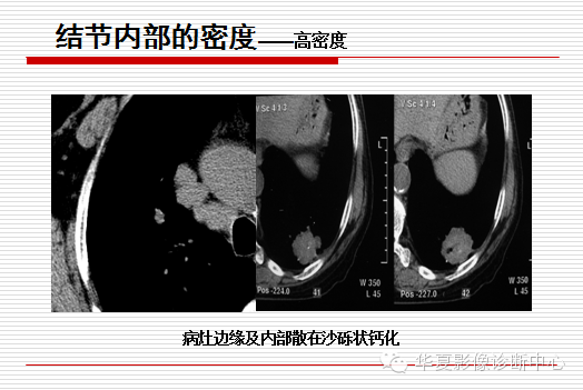 孤立性肺结节/肿块及相关CT征像判断的准则