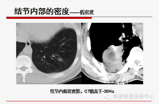 孤立性肺结节/肿块及相关CT征像判断的准则