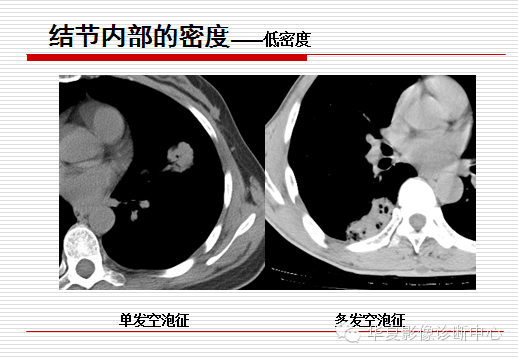 孤立性肺结节/肿块及相关CT征像判断的准则
