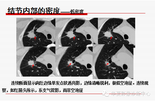 孤立性肺结节/肿块及相关CT征像判断的准则