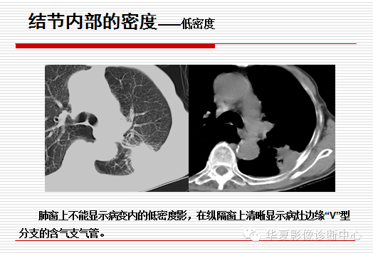 孤立性肺结节/肿块及相关CT征像判断的准则