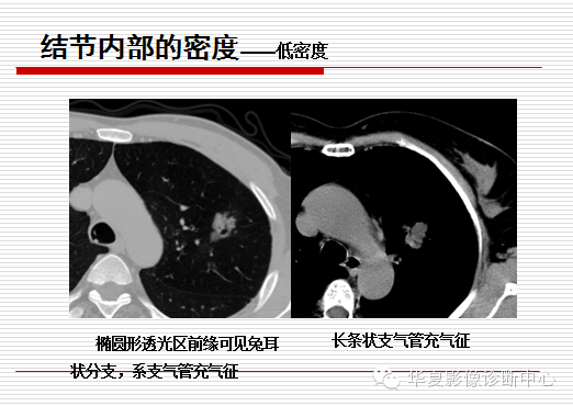 孤立性肺结节/肿块及相关CT征像判断的准则