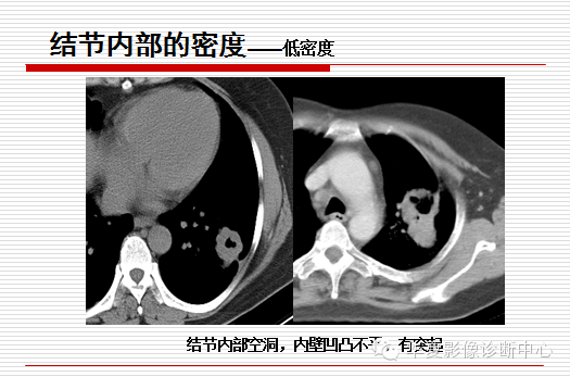 孤立性肺结节/肿块及相关CT征像判断的准则