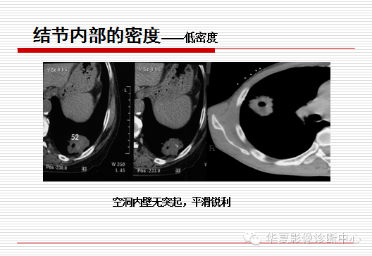 孤立性肺结节/肿块及相关CT征像判断的准则