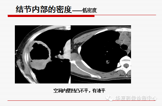 孤立性肺结节/肿块及相关CT征像判断的准则