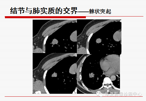 孤立性肺结节/肿块及相关CT征像判断的准则