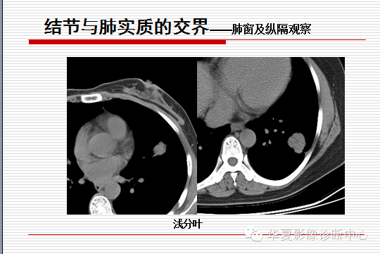 孤立性肺结节/肿块及相关CT征像判断的准则