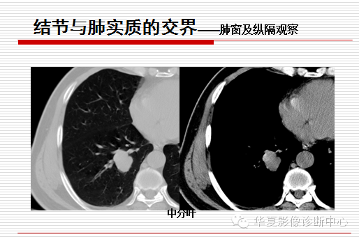 孤立性肺结节/肿块及相关CT征像判断的准则