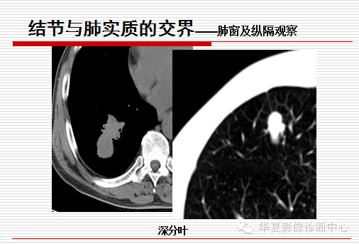 孤立性肺结节/肿块及相关CT征像判断的准则