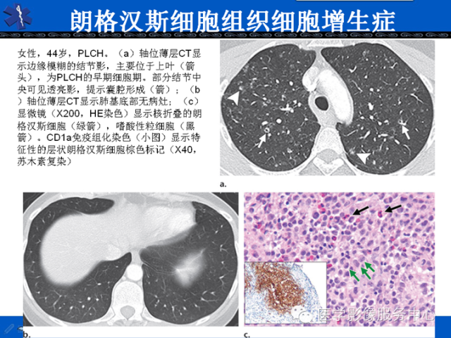 胸部组织细胞病变的影像学表现