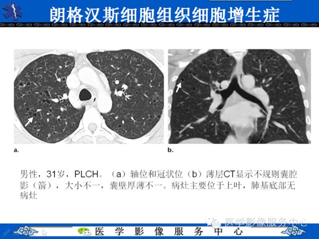 胸部组织细胞病变的影像学表现