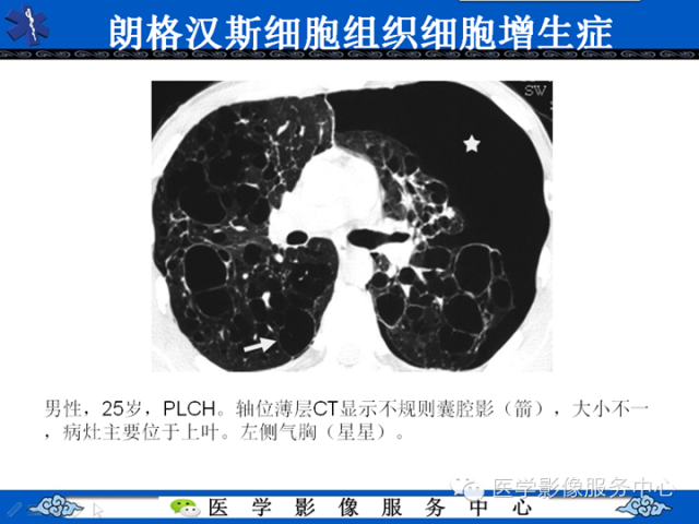 胸部组织细胞病变的影像学表现