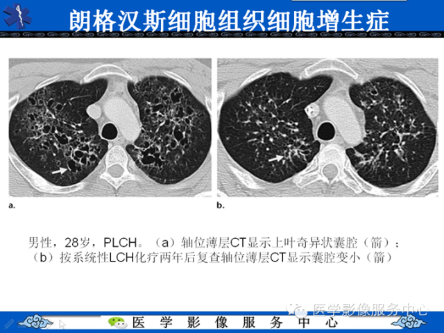 胸部组织细胞病变的影像学表现