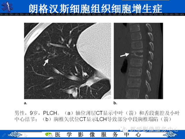 胸部组织细胞病变的影像学表现