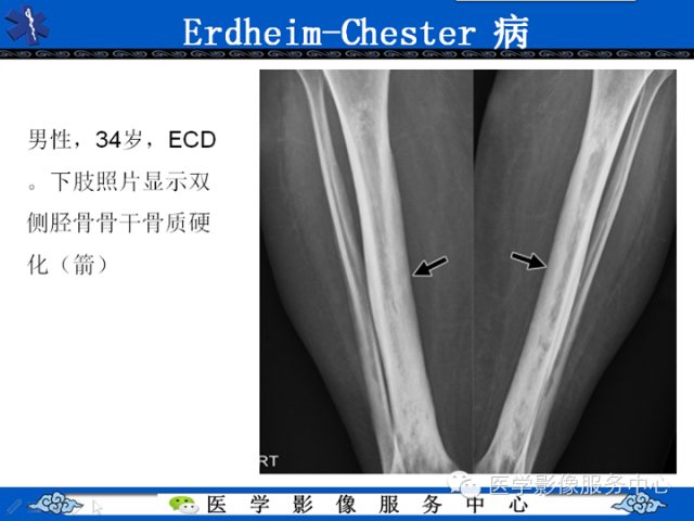 胸部组织细胞病变的影像学表现
