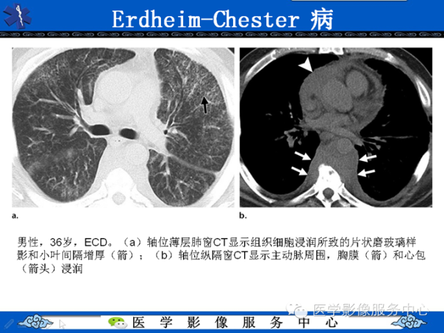 胸部组织细胞病变的影像学表现