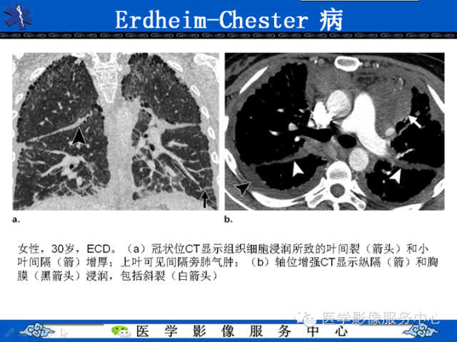 胸部组织细胞病变的影像学表现