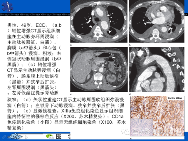 胸部组织细胞病变的影像学表现