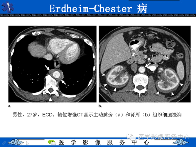 胸部组织细胞病变的影像学表现