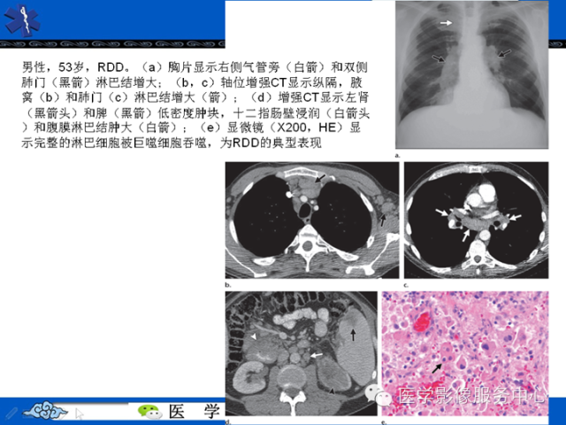 胸部组织细胞病变的影像学表现