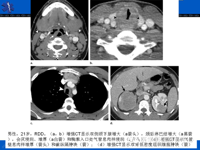 胸部组织细胞病变的影像学表现