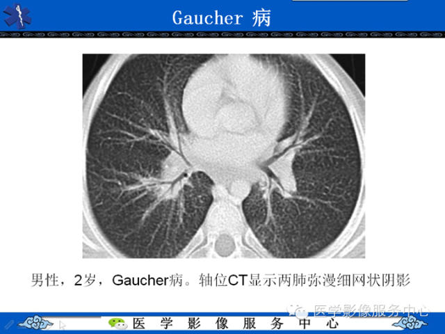 胸部组织细胞病变的影像学表现