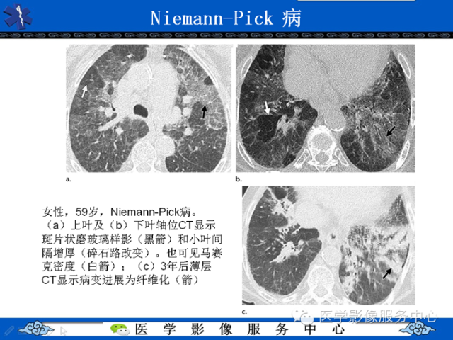 胸部组织细胞病变的影像学表现
