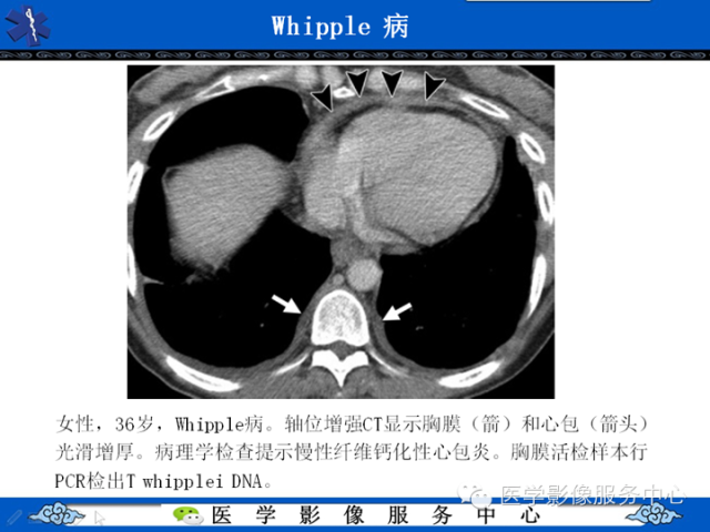 胸部组织细胞病变的影像学表现