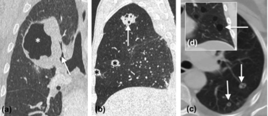 【思路拓展】哪些病变会引起肺空洞？