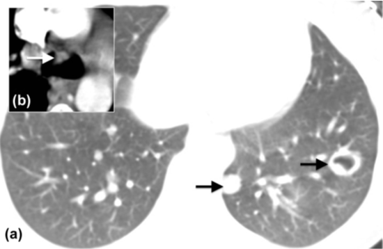 【思路拓展】哪些病变会引起肺空洞？
