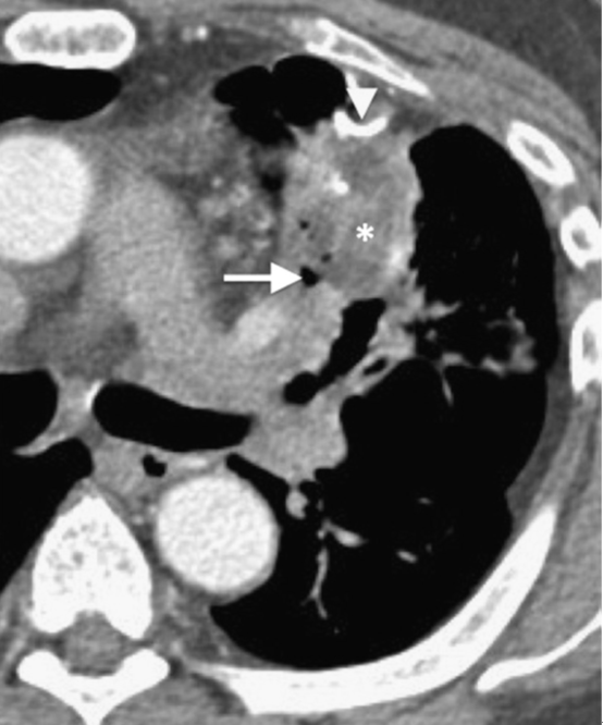 【思路拓展】哪些病变会引起肺空洞？