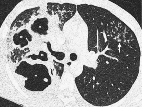 【思路拓展】哪些病变会引起肺空洞？