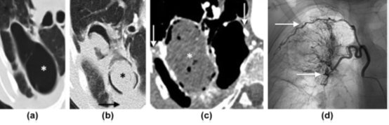 【思路拓展】哪些病变会引起肺空洞？