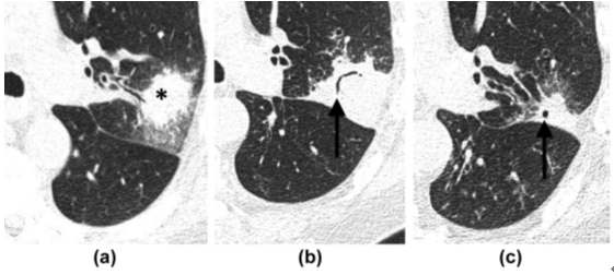 【思路拓展】哪些病变会引起肺空洞？